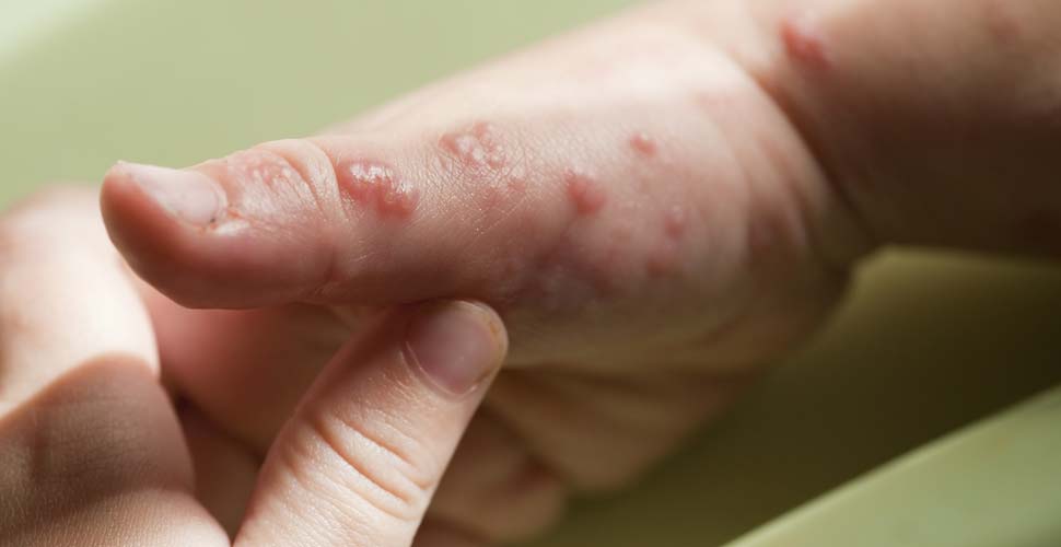 Dolor asociado a infección por Herpes Zoster